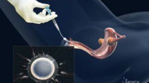 Мужское и женское бесплодие. Искусственная инсеминация.