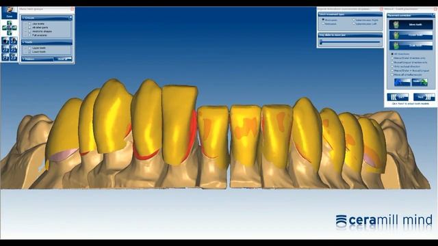 Ceramill Mind Case Design: Veneers + reduced posterior crowns смотреть онлайн