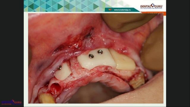 2018 11 20 Хабиев К Н Обзор остеопластических материалов для костной пластики смотреть онлайн