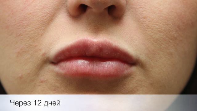 Увеличение объема губ смотреть онлайн