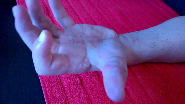 3. Bölüm Ergoterapi - El terapi : tendon ameliyat смотреть онлайн