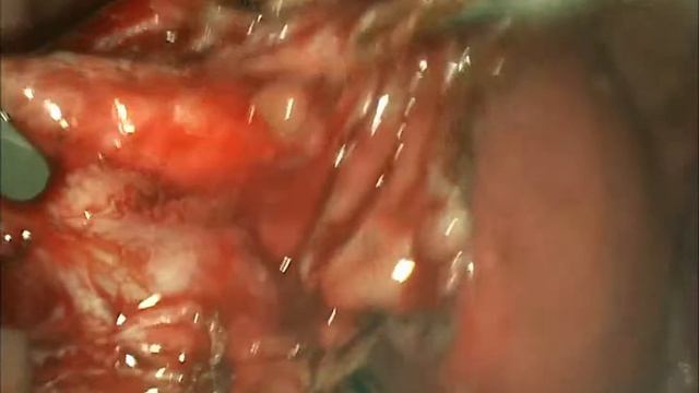 Удаление эндометриоидной кисты с использованием радиоволнового, монополярного крючка. смотреть онлайн