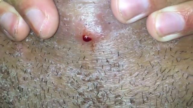 ОГРОМНЫЙ ЧИРИЙ  НА ЛОБКЕ У ДЕВУШКИ!!!!