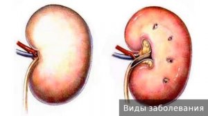 Острая почечная недостаточность. Как лечить острую почечную недостаточность.
