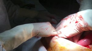 кишечная непроходимость