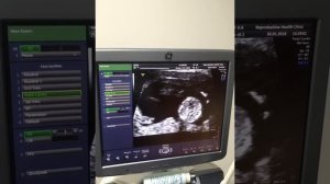 Первый скрининг 13 недель