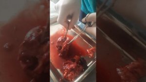 Камни удалённой почки "Нефрэктомия".