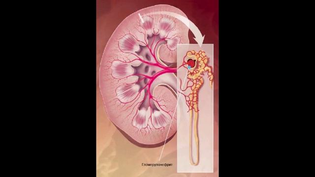 Гломерулонефрит ауруының белгілері қандай#бүйрекауырса смотреть онлайн