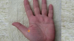 СуДжок. Болезни глаз