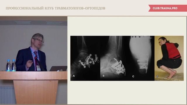 Травмы стопы при сочетанных и множественных повреждениях смотреть онлайн