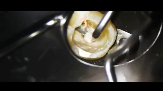 endodontic treatment , filling injector , эндодонтическое лечение зуба , пломбировка каналов смотреть онлайн