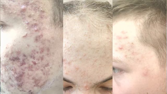 Вся правда о влиянии солнца на акне | Прыщи и солнце смотреть онлайн