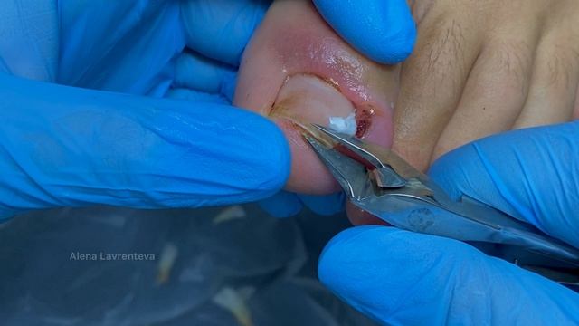 Гранулема - второй визит смотреть онлайн