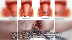 Лечение наружного геморроя у мужчин и женщин