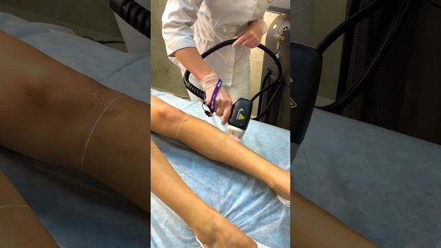 Лазерная эпиляция на аппарате Soprano с технологией Titanium смотреть онлайн