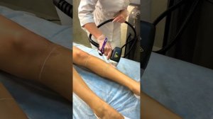 Лазерная эпиляция на аппарате Soprano с технологией Titanium