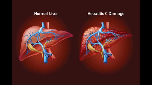 HEPATITIS C смотреть онлайн