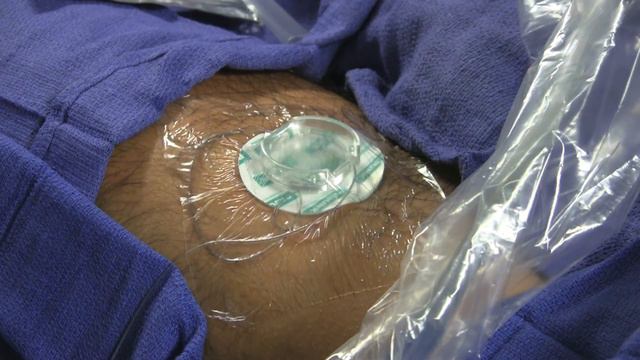 Nerve Block Cath Video смотреть онлайн