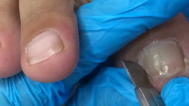 Provide patients with perfect ingrown toenail trimming【Crazy pedicure room】 смотреть онлайн