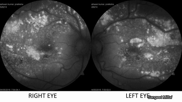 Masquerades of Central Serous Chorioretinopathy (CSCR) смотреть онлайн