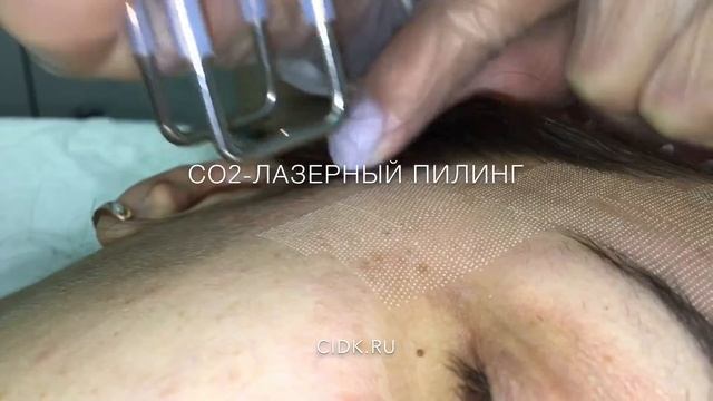 Лазерный пилинг + РФ-лифтинг на аппарате Deka smart Xide 2 dot смотреть онлайн