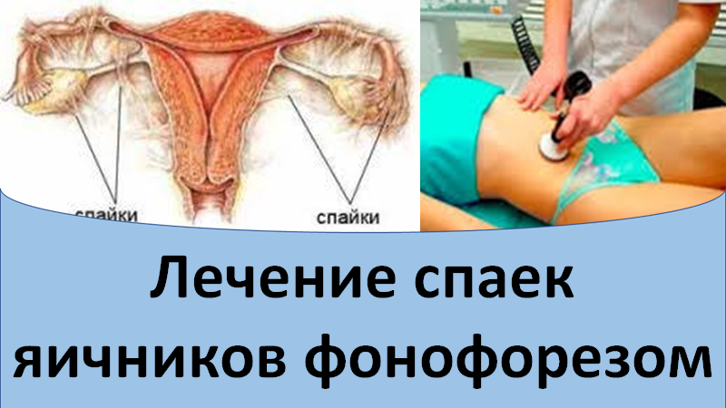 Лечение спаек яичников фонофорезом смотреть онлайн