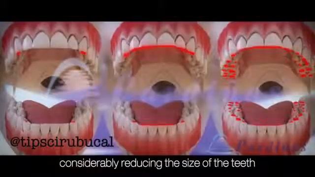 Синус-лифтинг смотреть онлайн