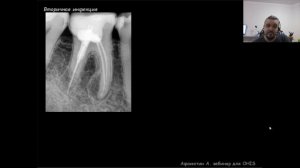 Вебинар №6 - Микробиология корневых каналов. Базовые знания для успешного принятия решений.