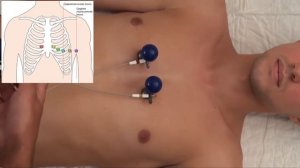 Быстрое наложение ЭКГ электродов