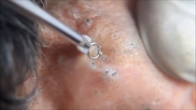 ЧЕРНЫЕ ТОЧКИ ПОД МИКРОСКОПОМ смотреть онлайн