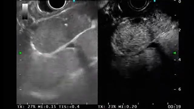 Mediastinum lymph node metastasis from prostate cancer смотреть онлайн