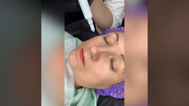 Холодная плазма. Аппаратное омоложение. Ростов смотреть онлайн