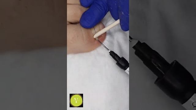 установка титановой нити и тампонады. смотреть онлайн