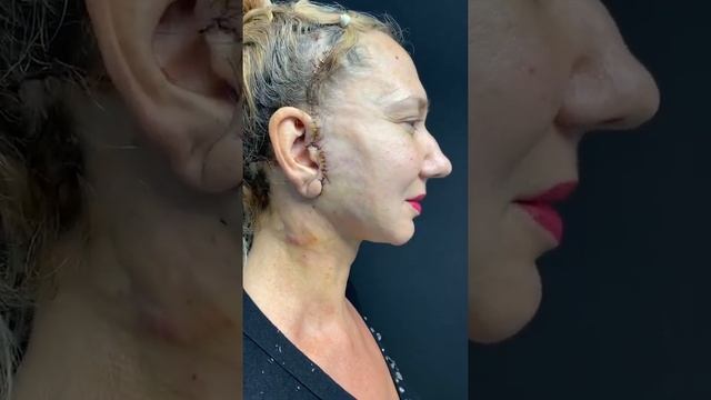 Подтяжка лица и шеи со смас лифтингом смотреть онлайн