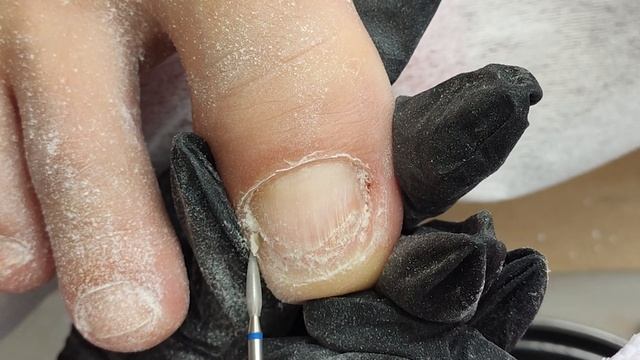 БОЛЯТ НОГТИ НА НОГАХ. ОНИХОГРИФОЗ И ОНИХОЛИЗИС. ТОЛСТЫЙ НОГОТЬ НА БОЛЬШОМ ПАЛЬЦЕ. Pedicure. 修腳 / 腳趾 смотреть онлайн