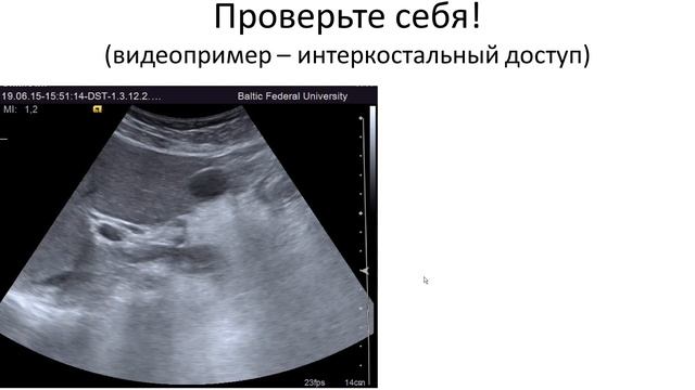 Кисты общего желчного протока. Болезнь Кароли смотреть онлайн