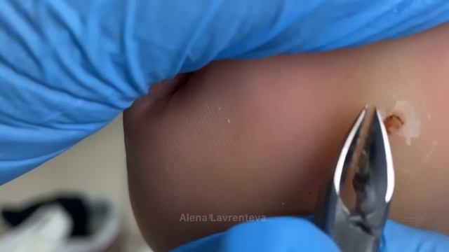 Нашли стекло внутри / Осколок стекла в ноге / Стержневая мозоль / на подошве стопы мозоль что делат смотреть онлайн