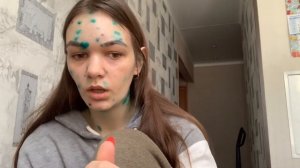 ВЕТРЯНКА//ВЕТРЯНАЯ ОСПА// СИМПТОМЫ, ПРИЗНАКИ, ЛЕЧЕНИЕ