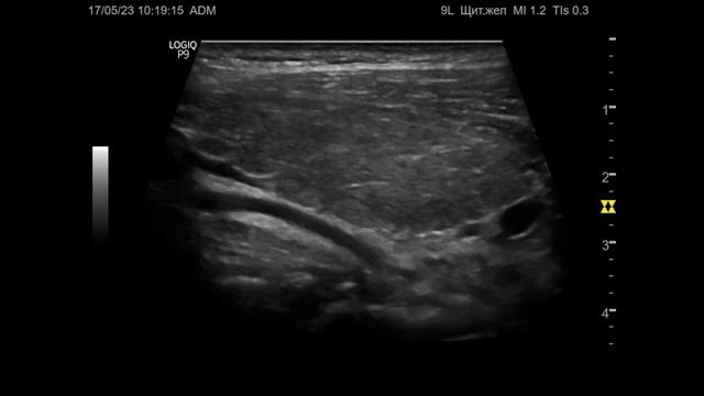 Ультразвуковая диагностика (УЗИ). Доктор Иогансен. Видеопримеры. Выпуск 14. Аутоиммунный тиреоидит. смотреть онлайн