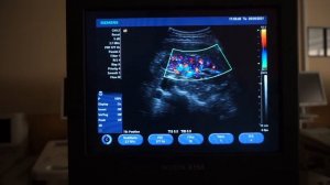 Siemens Acuson X150 обзор ультразвукового сканера