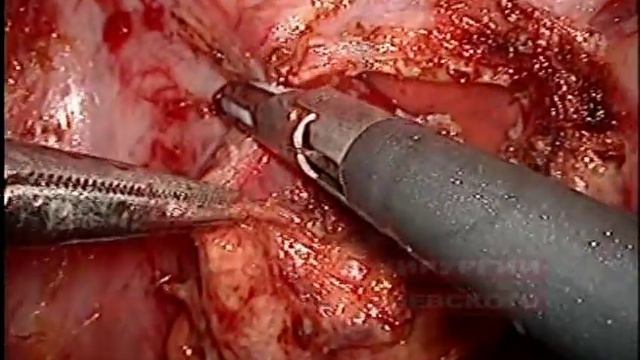 Лапароскопическая резекция желудка по поводу GIST