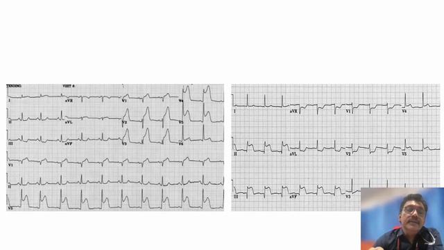 Myocardial Infarction || Clinical features & Management смотреть онлайн