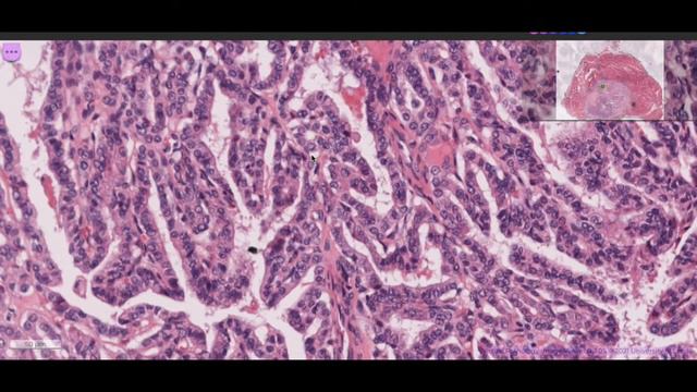 Papillary Thyroid Carcinoma 1 смотреть онлайн