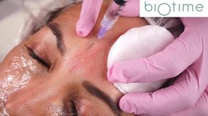 Biomatrix Topaz. Методика биоревитализации в технике микропунктурных инъекций