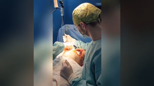 ? УВЕЛИЧЕНИЕ ГРУДИ. ПОДТЯЖКА ГРУДИ. ХИРУРГ ИРИНА ШВЕЦ ? смотреть онлайн