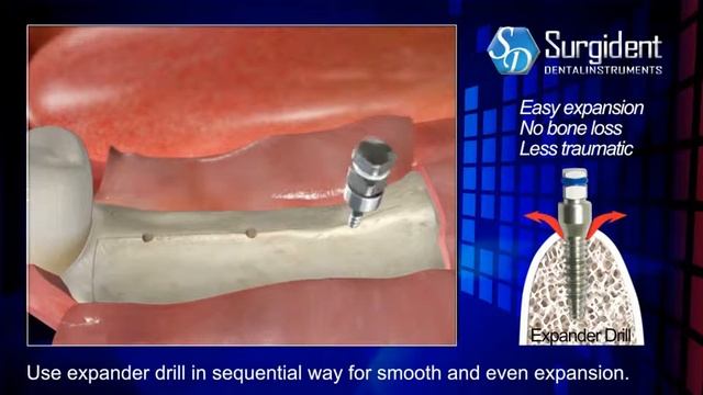 Набор для расщепления гребня с помощью экспандеров Bone Expander смотреть онлайн