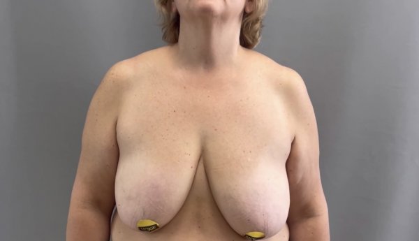 Уменьшение и подтяжка груди.