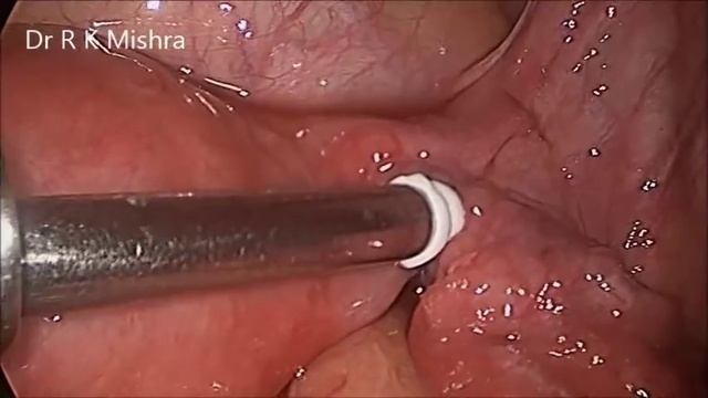 Dr. R.K. Mishra demonstrating Female Laparoscopic Sterilization by Falope Ring смотреть онлайн