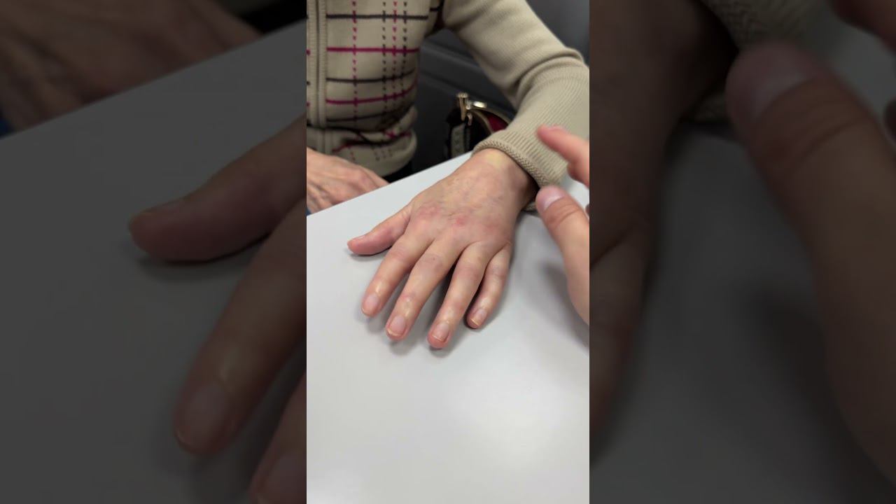 ГИПС ДВА МЕСЯЦА - Перелом лучевой кости - Последствия смотреть онлайн