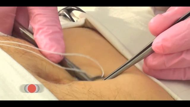 Техника выполнения лапароцентеза смотреть онлайн